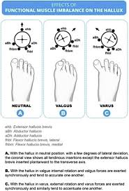 Image result for Hallux Varus