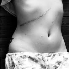 Check spelling or type a new query. Surgery Scar And Quotes Quotesgram