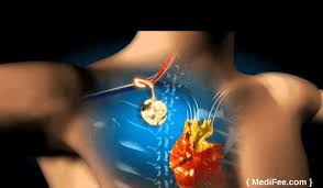 A catheter, or thin tube, connects the. What Is Chemoport Insertion And Placement Procedure