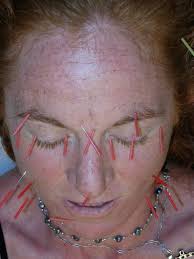 Facial Rejuvenation Cosmetic Acupuncture Luvlight