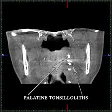 Image result for Tonsillolith