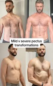 Image result for Pectus Excavatum