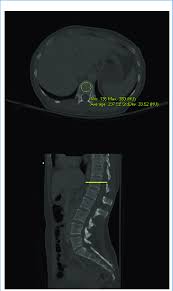The term lefort fractures is applied to transverse fractures of the midface. Patient With L1 Compression Fracture Download Scientific Diagram