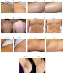 1 how much does laser hair removal cost in the us? 9 Laser Hair Removal Ideas Laser Hair Removal Hair Removal Laser Hair