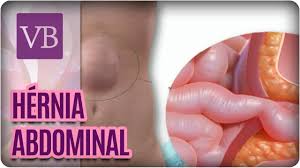 Hernia Abdominal Voce Bonita 19 10 16 Youtube