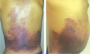 My veins are hard to find and some nurses/phlebotomists cannot find them and poke about causing pain and bruising and yet, at other times, like last week, there was no bruising at all. Hemolytic Anemia Due To Hematoma Formation After Deep Tissue Massage Consultant360