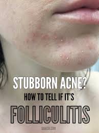 Image result for folliculitis symptoms