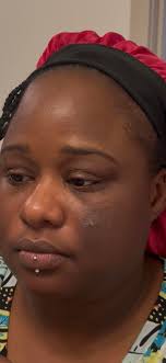 What to use for skin bumps?