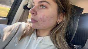 How to get rid of acne?