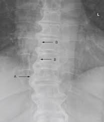 Large Flowing Right Sided Osteophytes Of The Thoracic Spine A Note The Translucent Area Between The Vertebr Spine Problems Radiology Imaging Bone Diseases