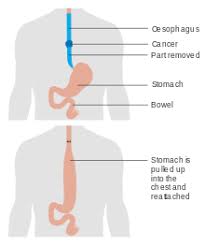 Esophageal Cancer Wikipedia