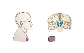 Image result for Thalamic Stimulation