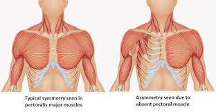 Dr Lee Breast Augmentation Korea Poland Syndrome Treatment Breast Surgery