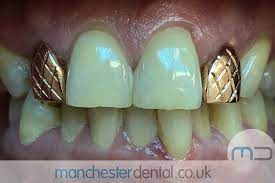 It can also be cleaned like natural teeth and cannot be removed. Gold Teeth Manchester Manchester Dental