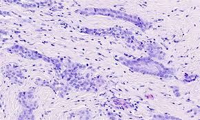 Infiltrating growth pattern, bland necrosis, frankly sarcomatoid areas, and evidence of metastases. Pathology Outlines Mesothelioma Pleura Epithelioid