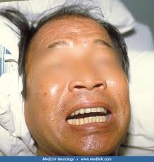 Image result for Tetanus