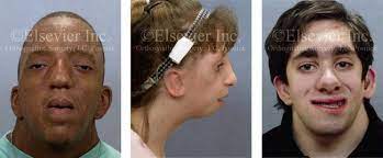 16 Complications Associated With Orthognathic Surgery Pocket Dentistry
