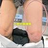 指揮中心說明，本案為30多歲男性，於5月12日接種第一劑az疫苗後，曾出現發燒等身體不適症狀，於3日後逐漸緩解。 自５月19日起，出現微燒、持續頭痛 判依「血栓併血小板低下症候群(thrombosis with thrombocytopenia syndrome, tts)臨床指引」及時診治，個案目前血小板值恢復中，狀況穩定。 Https Encrypted Tbn0 Gstatic Com Images Q Tbn And9gctkhrizstptmqenb Rqimdpb1t8ii0ptiyjxzv Ggwekoure9gp Usqp Cau