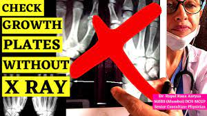 How To Check Growth Plates Without X Ray ? Height Growth After 18 ? Height  Increase Tips (Hindi) - Youtube
