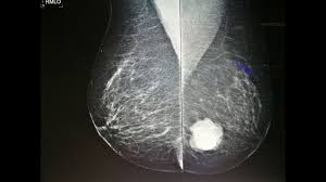 Image result for Mammogram Interpretation