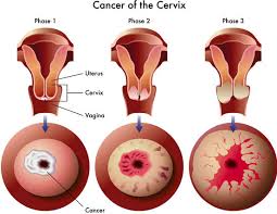 Cervical Cancer in Stages