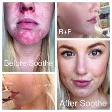 People comment to me all the time about how my skin looks great, especially  for a man in his early 50's. However, like virtually everyone, I have  issues with my skin. It's