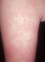 What are the best products for red bumps? Irritated About Bumps On Your Arms Hair And Nails Health And Beauty Beauty Remedies