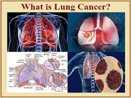 A cough that does not go away or. Lung Cancer Symptoms Causes Stages Treatment And More