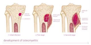 Image result for Osteomyelitis