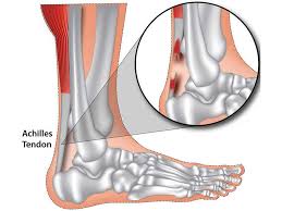 Diagram of the major cell components. 8 Effective Achilles Tendon Treatments Surgery In Scottsdale