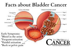 What is the first sign of bladder cancer? Dr Rajkumar Mathur Bladder Cancer