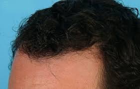زراعة الشعر بالتقسيط في السعودية 100 نتائج مضمونة