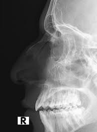 Nasal Bone Anatomy X Ray Radiology Case Radiopaedia Org