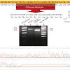 Ccr5 promoter polymorphisms associated with pulmonary tuberculosis in a chinese han the combination of cc chemokine receptor type 5(ccr5) and treg cells predicts prognosis in patients. 1