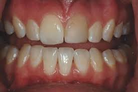 Maybe you would like to learn more about one of these? The Anterior All Ceramic Crown A Rationale For The Choice Of Ceramic And Cement British Dental Journal