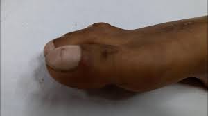 Image result for Clubbing nails feet