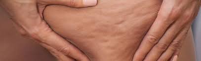 Se débarrasser des petits points rouges sur la peau. Cellulite Definition Et Symptomes Sante Sur Le Net