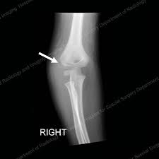 Injuries to the medial aspect of the distal humerus in young children can range from an avulsion fracture of the medial epicondyle. Elbow Fractures In Children An Overview Hss Edu