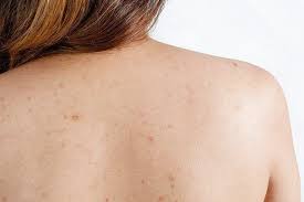 While there are many commercial treatments, natural remedies for acne scars are the safest for curing bacne scars and preventing bacne from recurring. Easy And Effective Home Remedies To Treat Back Acne Scars
