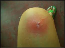 The human botfly, dermatobia hominis, is the only species of botfly that attacks humans. Surfing Medicine Case Report A Nicaraguan Stowaway