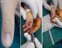 Image result for Glomus tumor