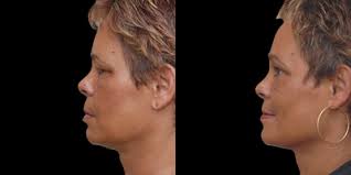 Cory S. Goldberg, BSc, MD, FRCS(C), Certified Plastic Surgeon