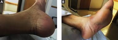 It is important to know the signs and symptoms of bcc. A Patient With Breast Cancer And A Rash On Her Hands And Feet Cleveland Clinic Journal Of Medicine