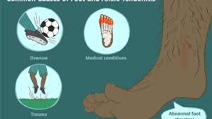 Flexor tendons are the tendons of the fingers. Treatment For Tendonitis Of The Foot And Ankle