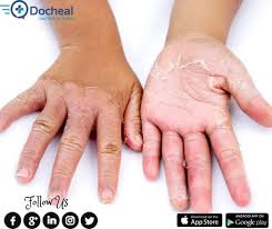 Maybe you would like to learn more about one of these? What Causes Skin To Peel Off Quora