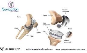 For Total Knee Hip Arthroplasty Proper Implant Alignment Is An Important Factor For Minimizing Long Te Knee Arthroscopy Total Knee Replacement Hip Replacement