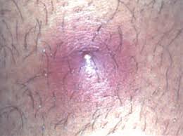 Ingrown pubic hair bumps and lumps form after the edge of the cut hair becomes sharp and grows backwards into the skin. Mrsa Skin Infections Frequently Asked Questions Momsteam