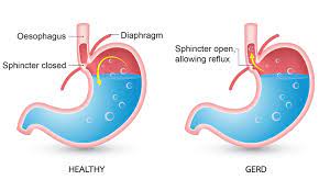 Can Gastric Problems Cause Chest Pain Health Plus