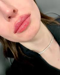 her goal- to vertically raise and correct the upper lip asymmetry with my  Russian lip technique. swipe to see the before and after 🤍 #russianlip  #lipfiller #lips #beforeandafterlipfillers #restylane #juvederm  #minneapolis #minnetonka #