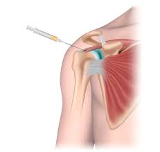 This small muscle is located at the top of the shoulder and helps raise the arm away from the body. Rotator Cuff And Shoulder Injections O360 Content Library